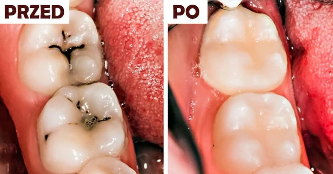 Ile kosztuje plomba światłoutwardzalna na NFZ? Sprawdź, co warto wiedzieć