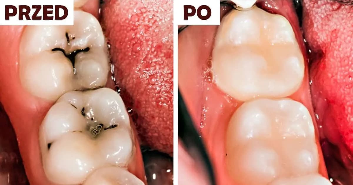 Ile kosztuje plomba światłoutwardzalna na NFZ? Sprawdź, co warto wiedzieć