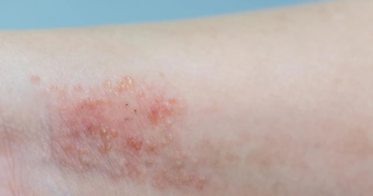 Jakie leki na atopowe zapalenie skóry skutecznie łagodzą objawy?