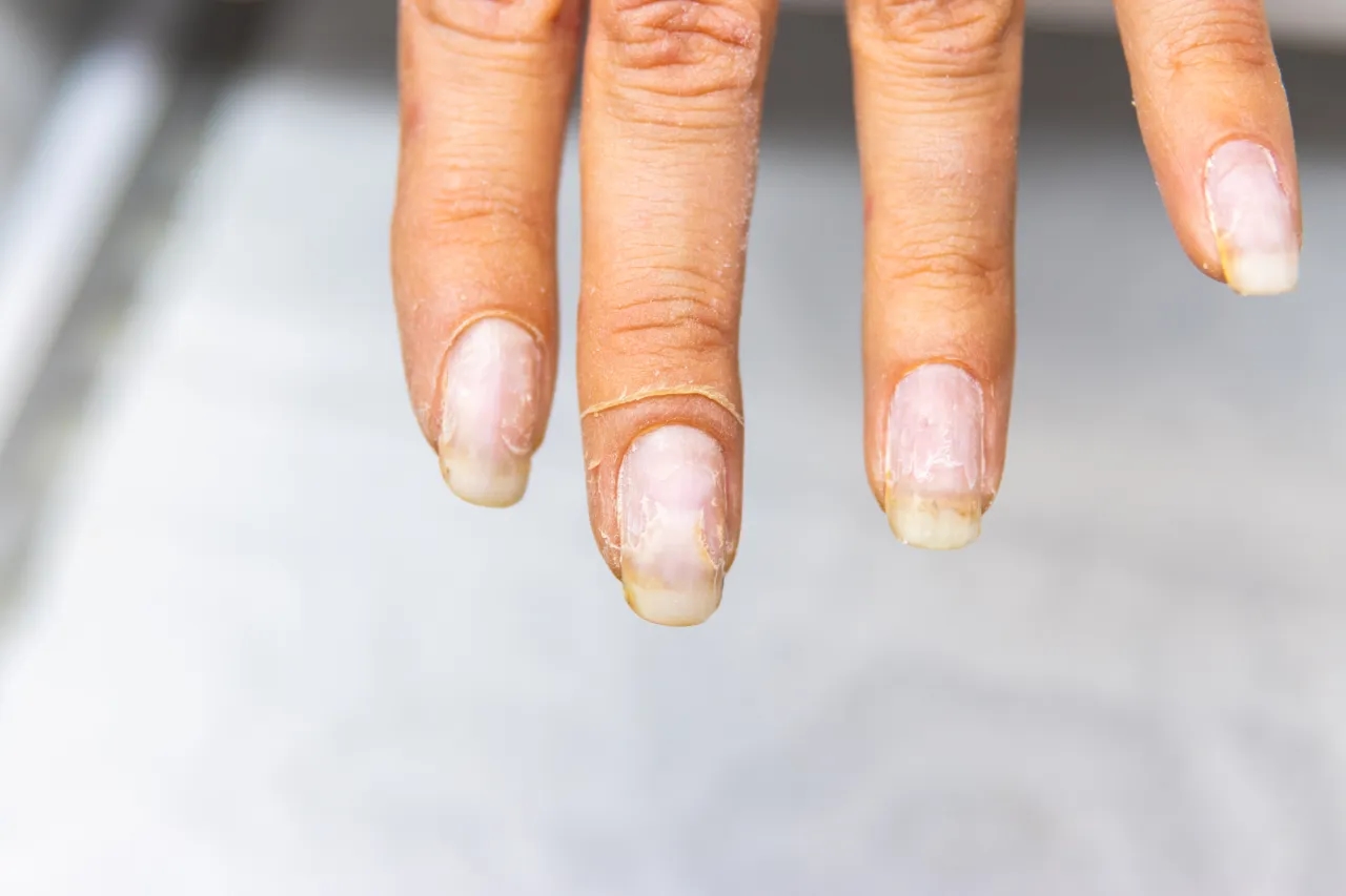 Onycholiza - jak sobie z nią radzić i jakie preparaty wybrać?