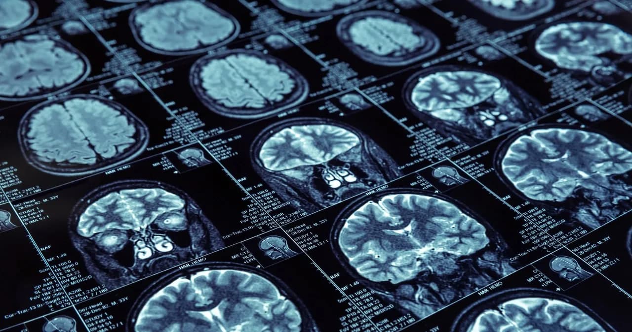 Jak zapobiec Alzheimerowi: skuteczne metody ochrony zdrowia mózgu